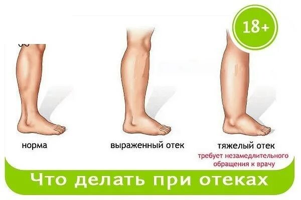 Что делать при отечности. Что делать при отечности