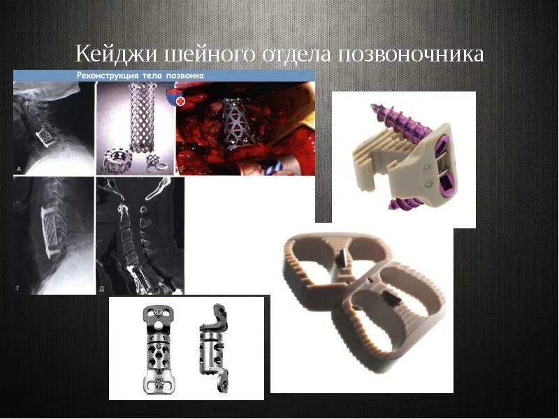 Установка кейджа в позвоночнике
