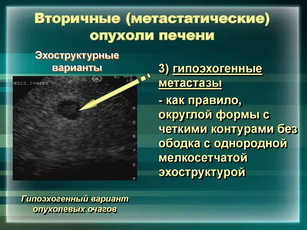 Доброкачественные и злокачественные опухоли печени. Доброкачественные новообразования печени. Вторичные (Метастатические) опухоли печени. Доброкачественные образования печени на УЗИ. Гиперваскулярное образование печени