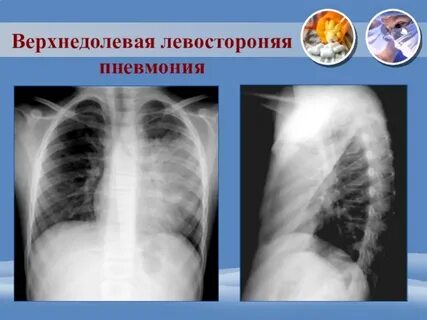 Левосторонняя пневмония у ребенка