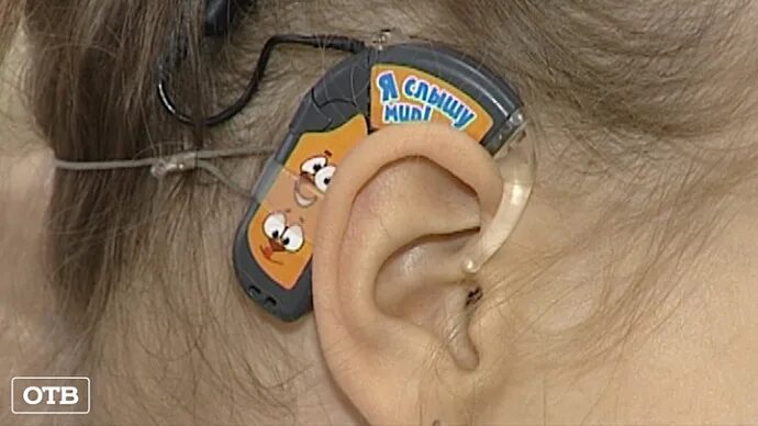 Операция на ухо на слух. Кохлеарный имплант Кохлер. Имплант слуховой аппарат.