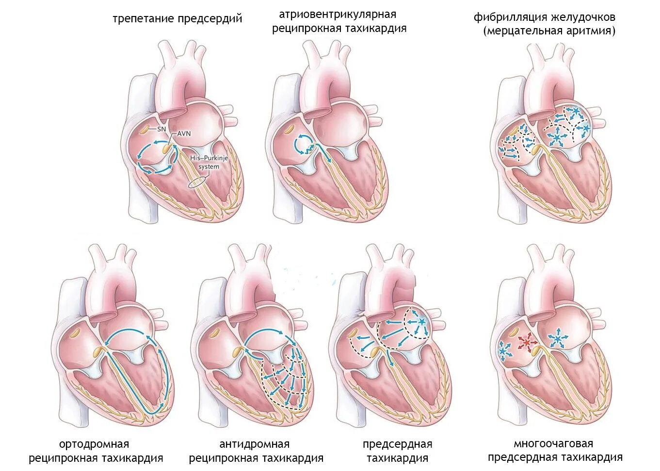 Сердце учащенное сердцебиение. Тахикардия. Физиологическая тахикардия. Тахикардия сердца. Виды тахикардии.