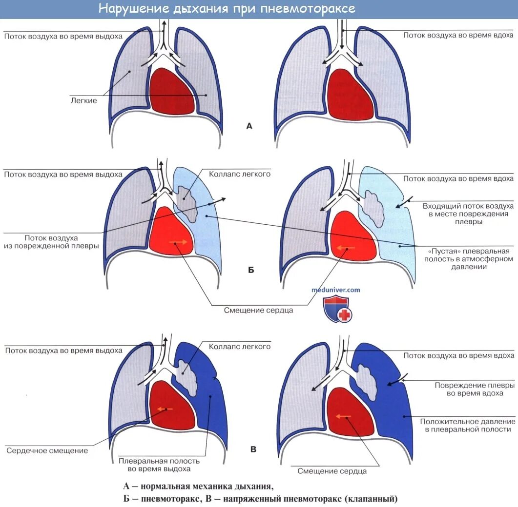 Клапанный пневмоторакс схема. Напряженный пневмоторакс классификация. Клапанный пневмоторакс классификация. Пневмоторакс механизм нарушения дыхания. Наличие крови в плевральной полости