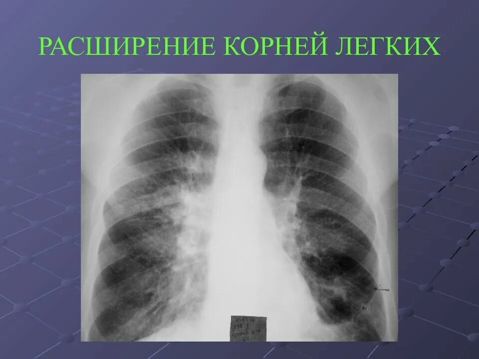 Корни легких. Корни легких на рентгене. Корень легкого рентген. Что значит легкие расширены