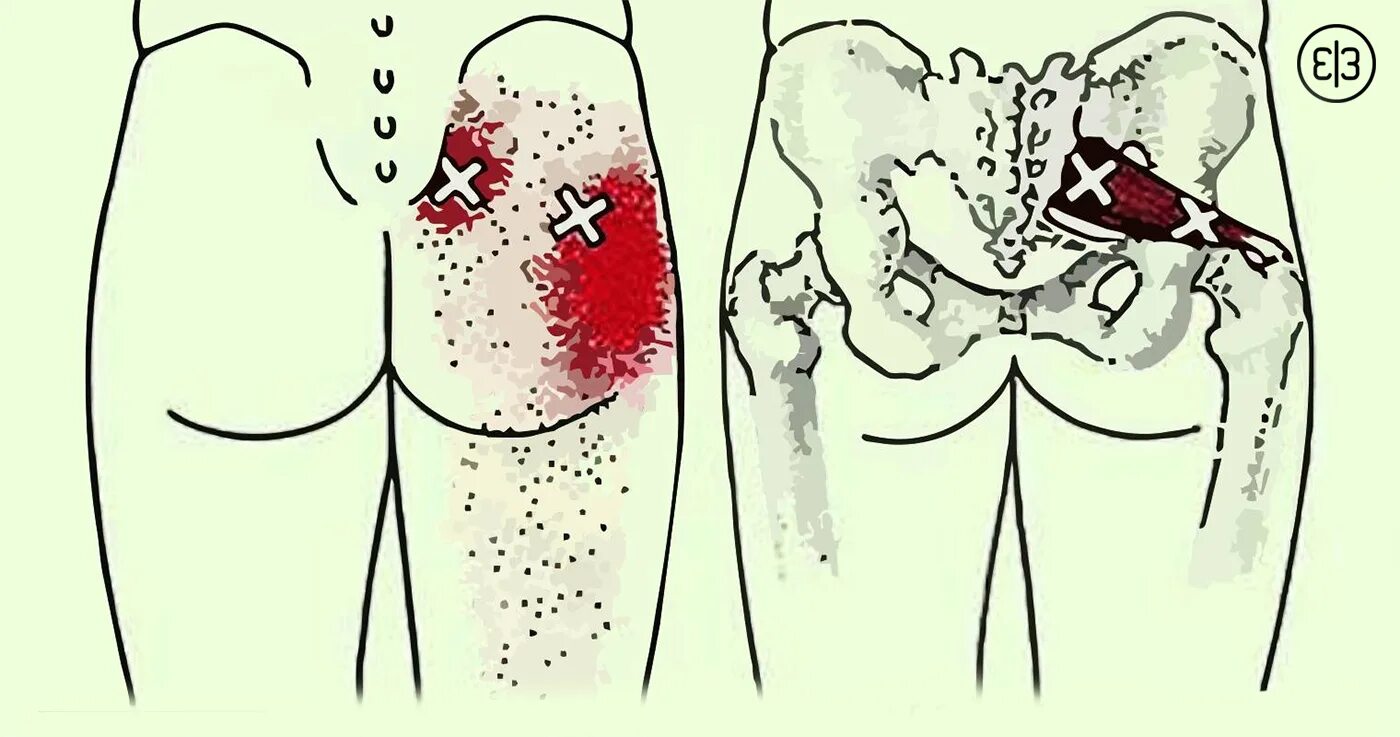 Сильно болят уколы что делать. Синдром грушевидной мышцы ягодицы. Прострел седалищного нерва. Седалищный нерв при уколе в ягодицу. Седалищный нерв левой ягодицы.