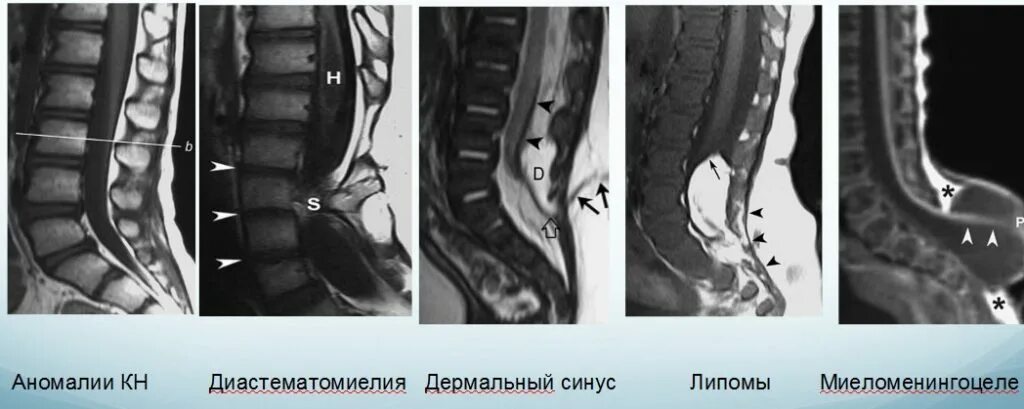 Фиксированный спинной. Спинальный дизрафизм (спина бифида). Грыжа спинного мозга спина бифида. Спинномозговая грыжа мрт. Рахишизис пояснично-крестцового.