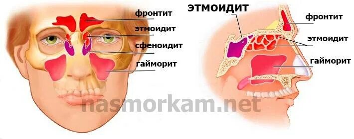Сфеноидит форум. Хронический гайморит этмоидит фронтит. Острый катаральный этмоидит гайморит. Острый этмоидит этиология.