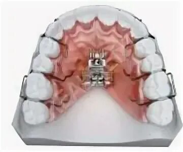 Аппарат хасса. Аппарат ортодонтический Бертони. Ортодонтическая пластинка Бертони. Ортодонтический аппарат с винтом Бертони. Ортодонтическая пластинка с винтом Бертони.