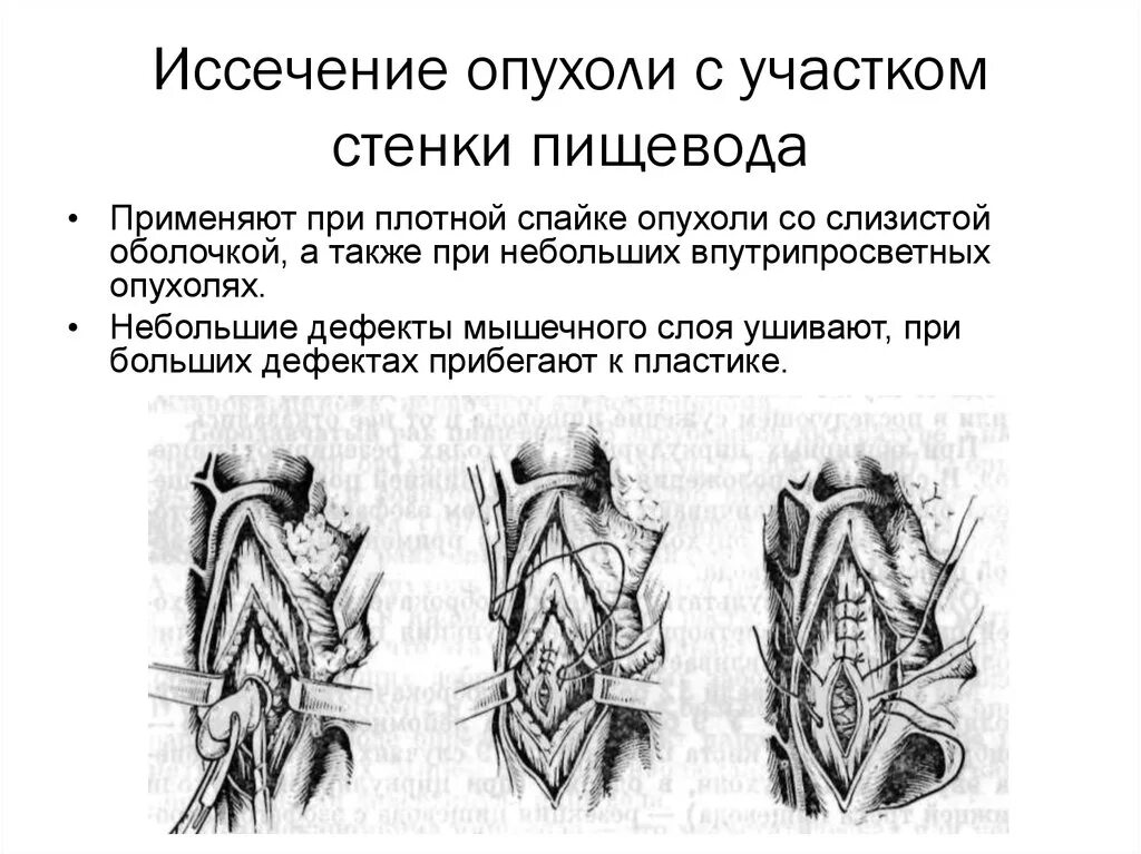 Резекция иссечение. Резекция иссечение