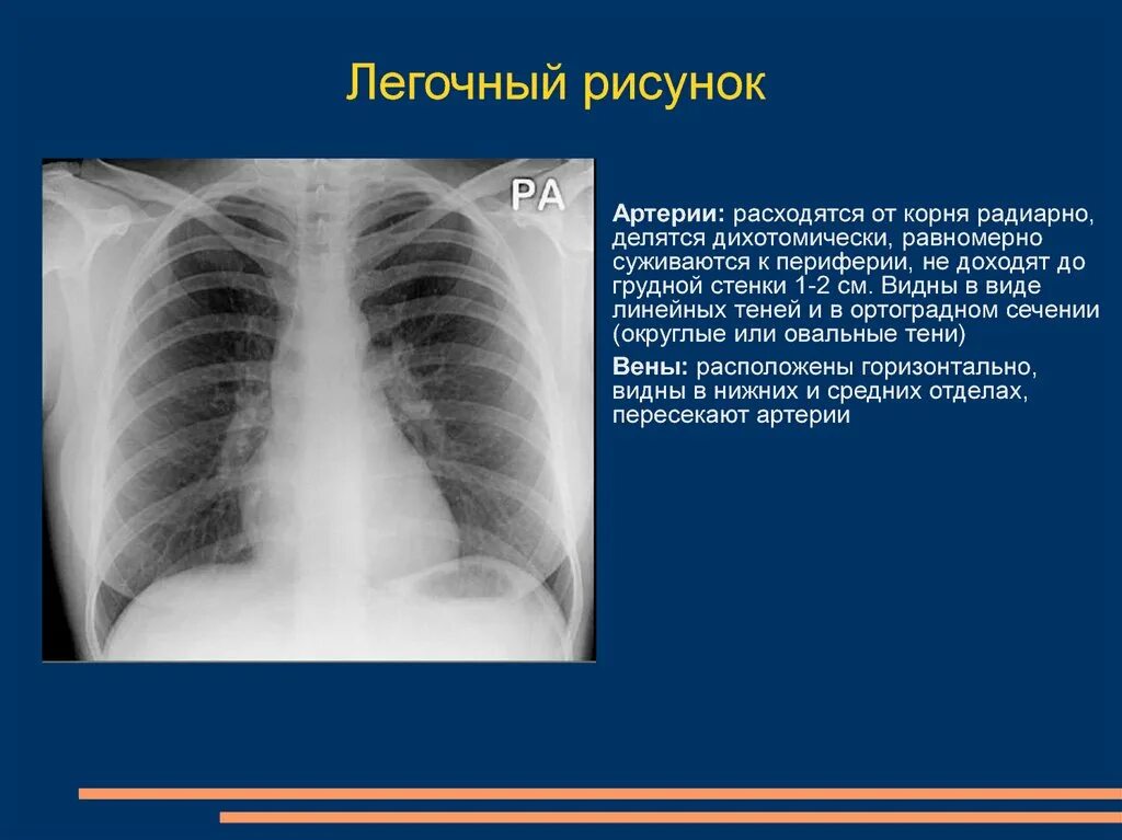 Какие изменения в легких. Лучевая диагностика при патологии корня легкого. корни легких на рентгене в норме. рентген органов грудной полости норма. патология корня легкого заболевания.