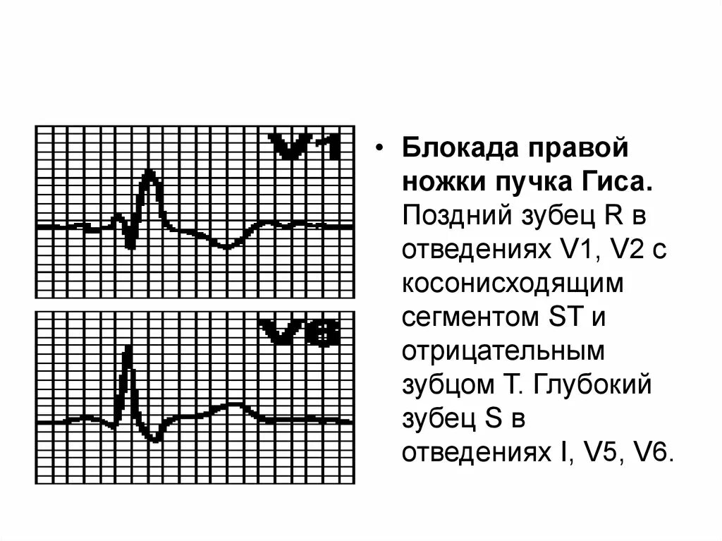 Блокада правой ножки желудочка. Блокада правового пучка Гиса. Ишемическая блокада правой ножки пучка Гиса. Электрическая ось сердца при блокаде правой ножки пучка Гиса. Блокада правой ножки пучка Гиса на ЭКГ.