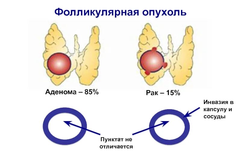 Чем аденома отличается от рака. Фолликулярная опухоль щитовидки. фолликулярная аденома. фолликулярная аденома щитовидной железы. фолликулярные новообразования.