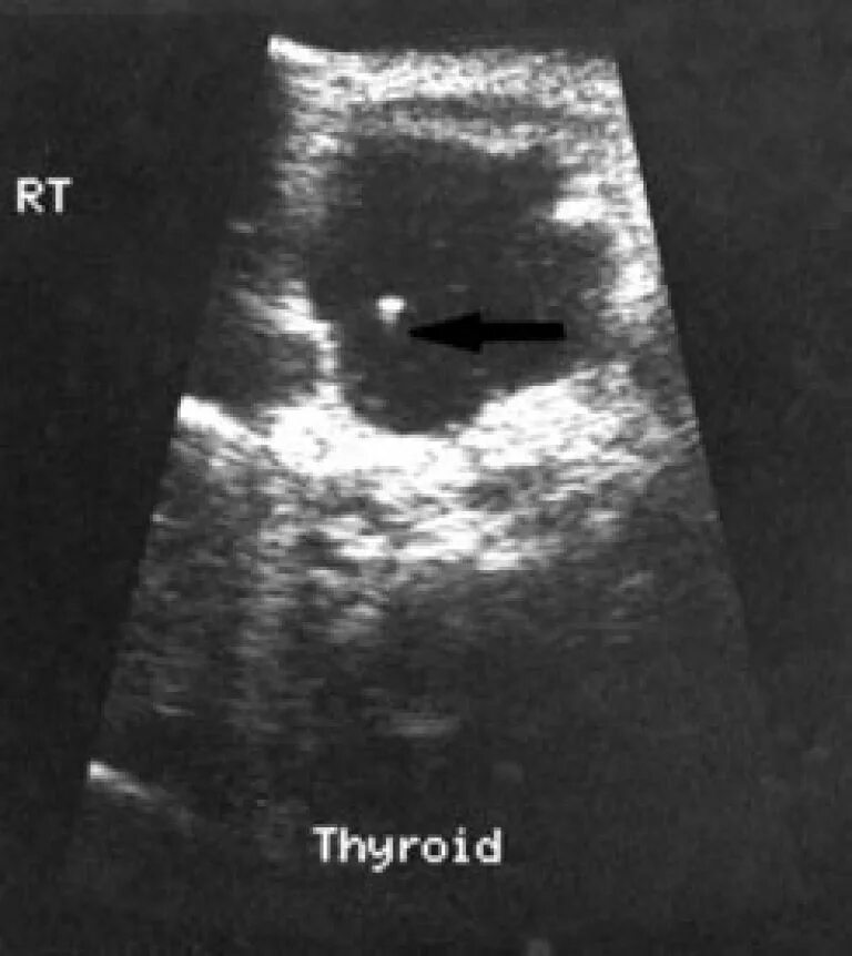Киста щитовидной у мужчин. Киста щитовидной железы на УЗИ. Кистозное образование щитовидной железы УЗИ. Коллоидные кисты в щитовидной железе на УЗИ.