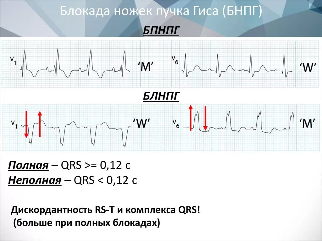 Нарушение блокады гиса. ЭКГ при блокаде пучка Гиса. Блокада ПНПГ на ЭКГ. Полная блокада пучка Гиса на ЭКГ. Полная блокада ПНПГ на ЭКГ.