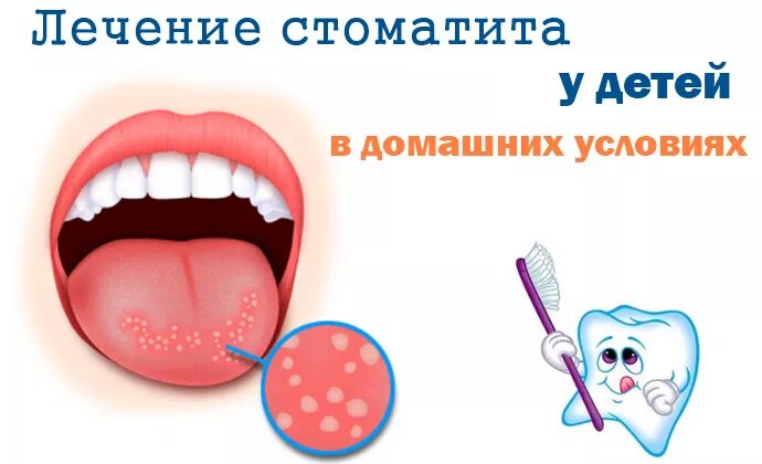 Как быстро и эффективно вылечить стоматит. Как быстро и эффективно вылечить стоматит