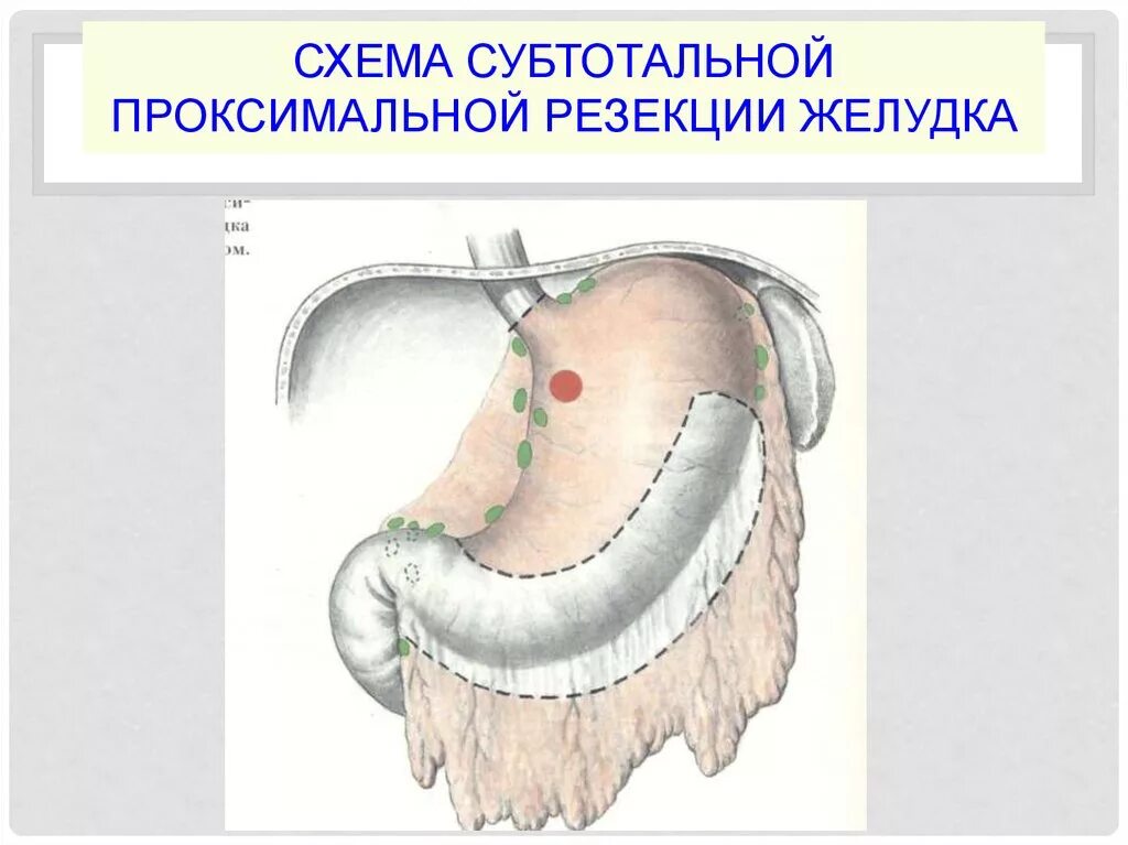 Последствия операции желудка. Проксимальная субтотальная резекция желудка. Проксимальная субтотальная резекция желудка схема. Субтотальная резекция желудка операции. Резекция желудка проксимальная субтотальная комбинированная.