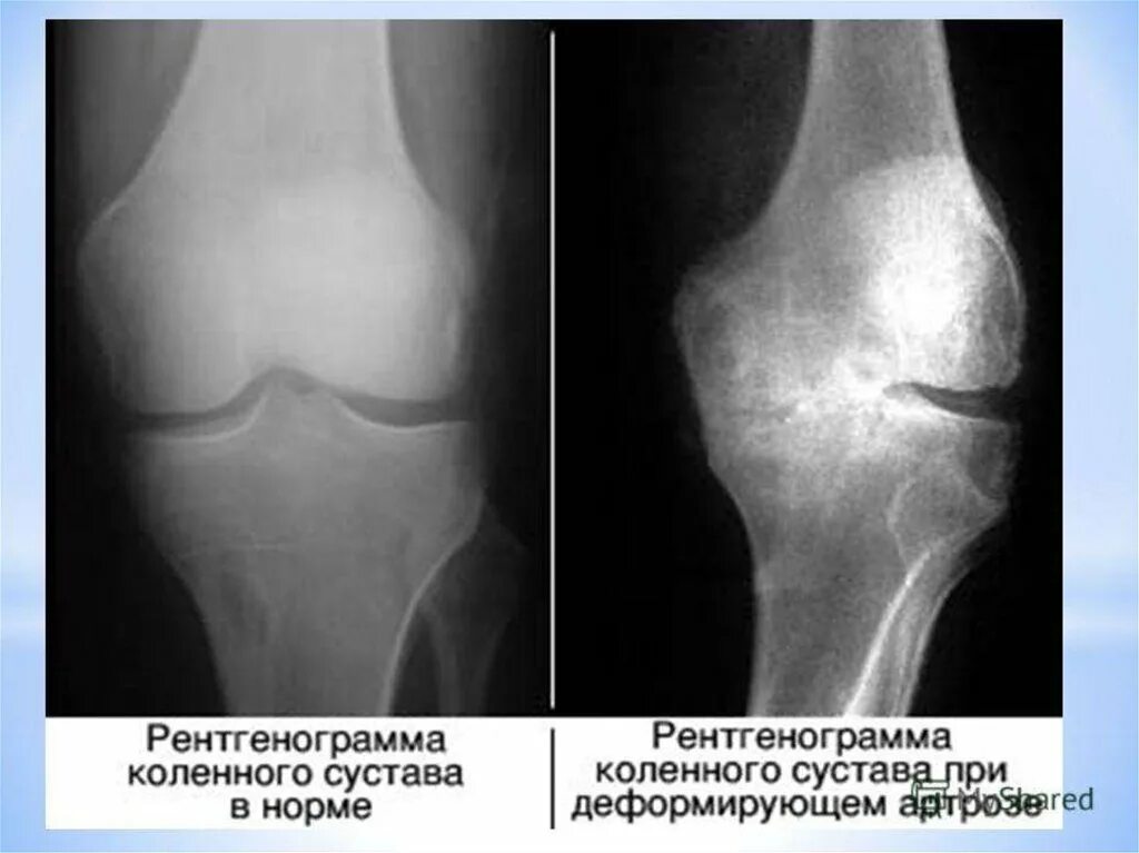 Артроз коленного сустава рентгенограммы. Рентген левого коленного сустава норма. Деформирующий артроз коленного сустава 3 степени. Артропатия коленного сустава рентген. Сужение коленных суставов