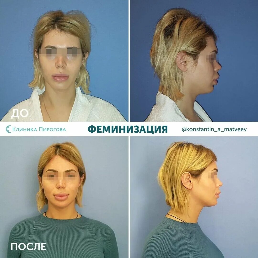 Операция по феминизации лица. Операция по феминизации. Феминизация лица. Феминизация лица. Пластическая операция по феминизации лица.