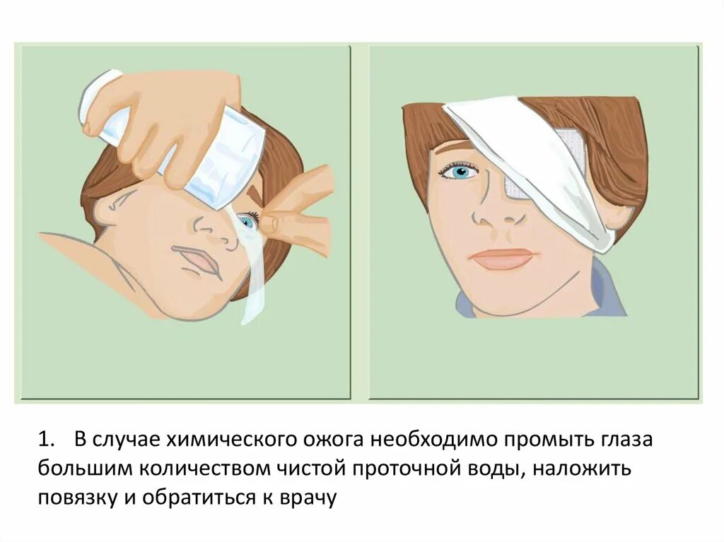 При ожогах глаз необходимо. Оказание помощи при ожоге глаз. Оказание первой помощи при ожогах глаз. Оказание помощи при химическом ожоге глаз.