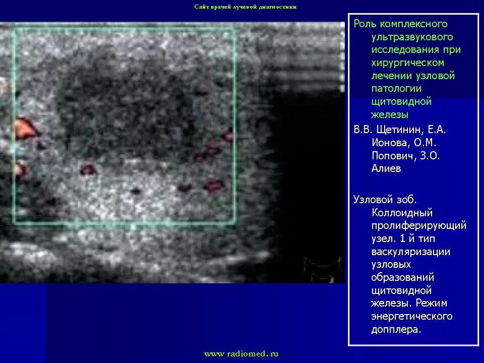 Можно ли перед узи щитовидной железы есть. Лимфатический узел щитовидной железы УЗИ. Узловая коллоидная гиперплазия щитовидной железы УЗИ. Узловой зоб щитовидной железы на УЗИ. Фолликулярные узлы щитовидной железы УЗИ.