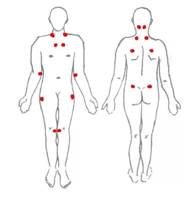Точки болезненности. Фибромиалгия триггерные точки. Фибромиалгия болевые точки. Фибромиалгия болезненные точки. Триггерные точки при фибромиалгии.