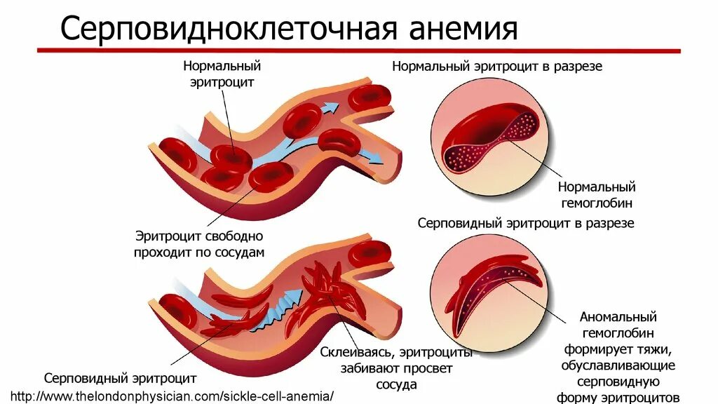 Серповидные эритроциты анемия. Серповидно клеточная анемия. форма эритроцитов при серповидноклеточной анемии. при серповидно-клеточной анемии гемоглобин:. серповмдно клеточная анемия.