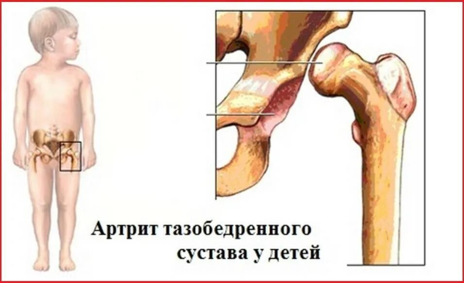 У ребенка щелкают суставы