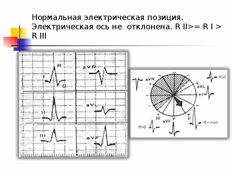 Вертикальная позиция сердца. Нормальная электрическая ОСТ. Нормальная электрическая ось. Электрическая ось вертикальная. Электрическая ось не отклонена.