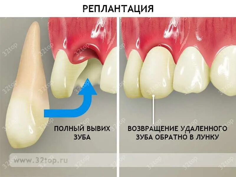 Вывих зуба: причины, симптомы, лечение