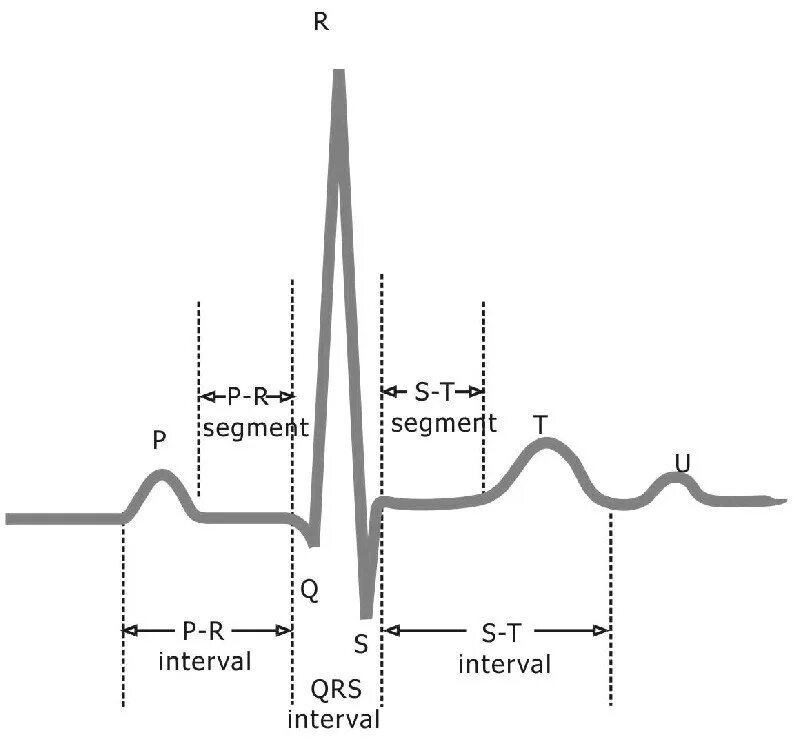 Qrs на экг что это. Комплекс QRS норма. Комплекс QRS на ЭКГ. Патология QRS на ЭКГ. Сигнал ЭКГ зубцы и интервалы.
