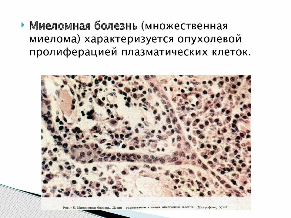 Миеломная болезнь что. Множественная миелома макропрепарат. Биопсия костного мозга при множественной миеломе. Миеломная болезнь поражение костей. Полиморфноклеточная миелома.