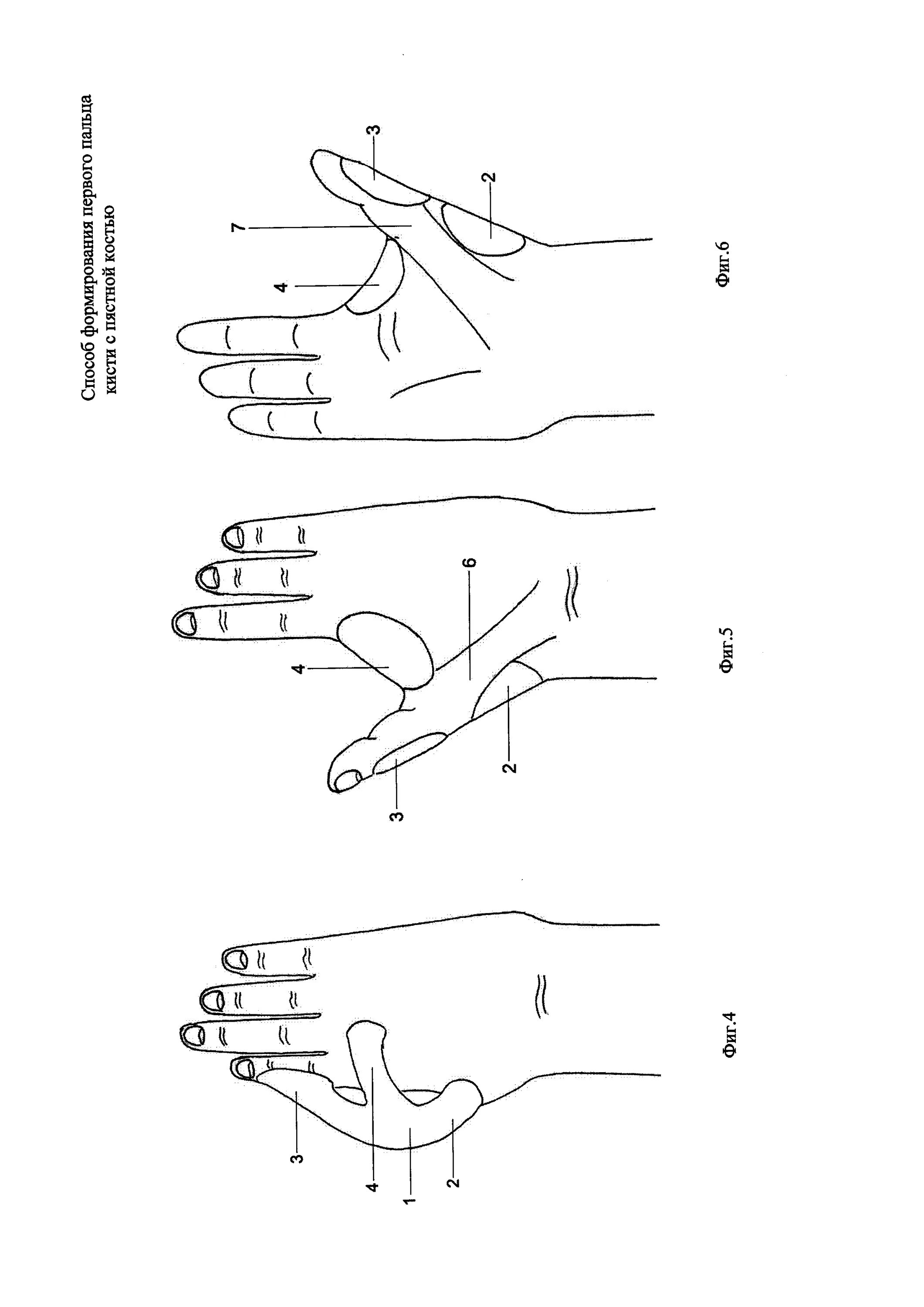 Пальцев 1 том. Первый палец кисти. Нумерация пальцев кисти. Первый палец кисти это какой.