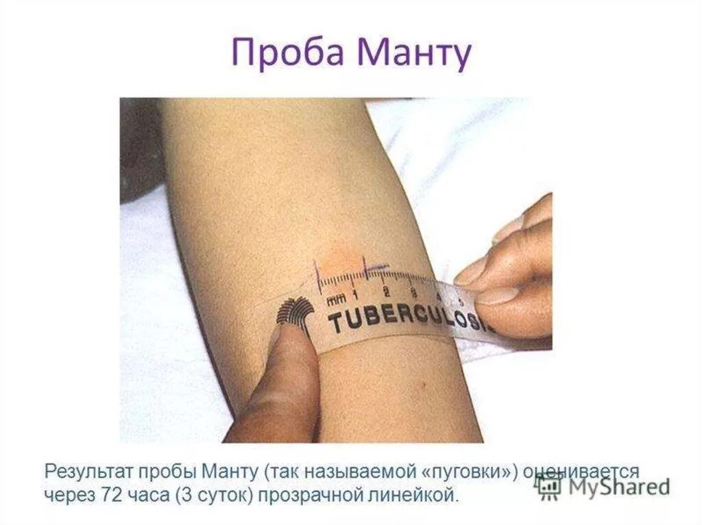 Можно мочить манту в первый день. Проба манту оценка результата туберкулеза. туберкулиновая проба реакция манту. результат прививки манту норма.