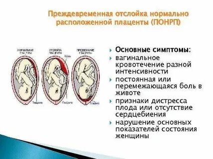 Признаки отслойки при беременности