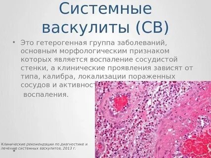 Воспаление сосудов лечение