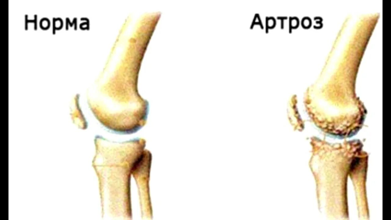 Артроз коленного сустава название. Дисплазия пателлофеморального сочленения коленного сустава. Деформирующий артроз пателлофеморального сочленения. Деформирующий артроз 3 степени. Пателлофеморальный артроз 1 степени.