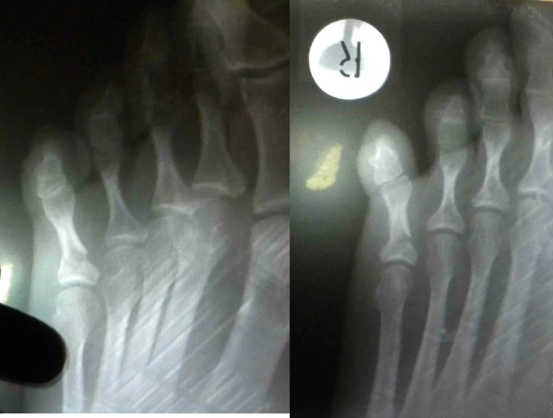 Ногтевой фаланги пальца ноги. Перелом фаланги пальца стопы рентген. Краевой перелом фаланги. Перелом фаланги пальца на ноге рентген. Оскольчатый перелом ногтевой фаланги рентген.