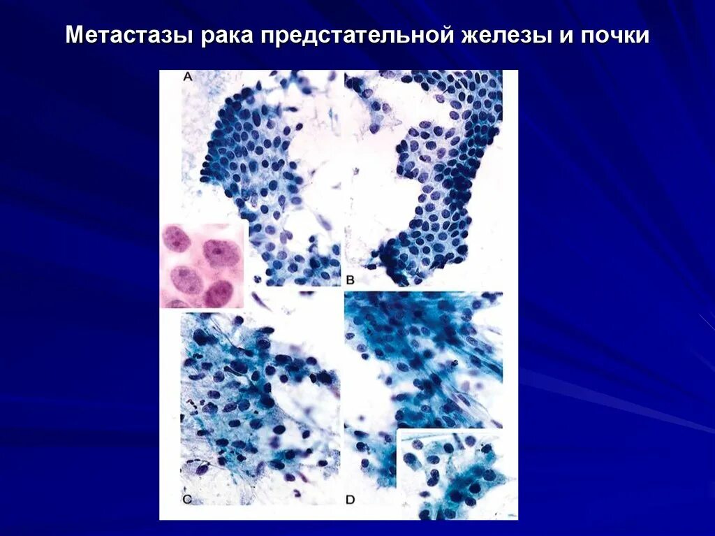 Метастазы в кости при раке предстательной