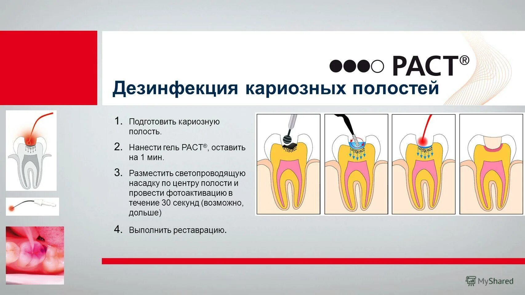 антисептическая обработка кариозной полости. медикаментозная обработка кариозной полости. ошибки при медикаментозной обработке кариозной полости. медикаментозная обработка полости зуба. протравливание кариозной полости.