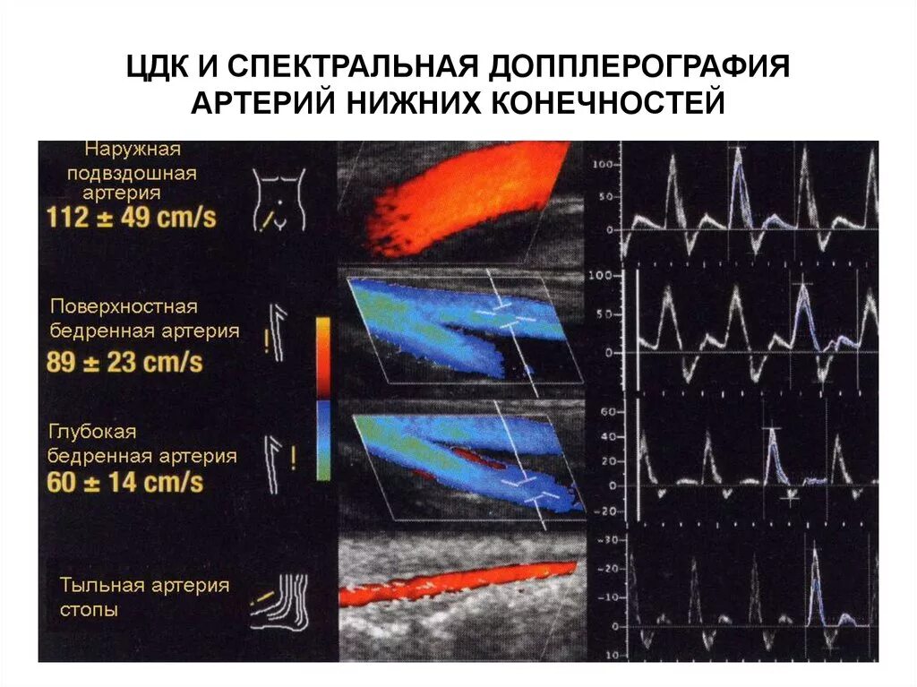 Что такое уздг. Норма ультразвуковых исследований артерий нижних конечностей. Нормы УЗИ сосудов нижних конечностей. УЗИ артерий нижних конечностей норма. Показатели УЗИ вен нижних конечностей норма.