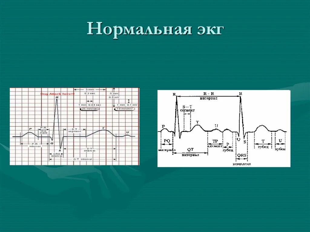 Кардиограмма норма. Нормальная кардиограмма. экг. нормальная кардиограмма экг. изображение нормальной экг.