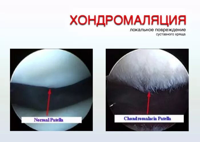 Хондромаляция медиальных мыщелков 4. Хондромаляция суставного хряща степени. Хондромаляция коленного сустава 3 стадия. Хондральное повреждение надколенника. Хондромаляция надколенника 1 и 2 степени.