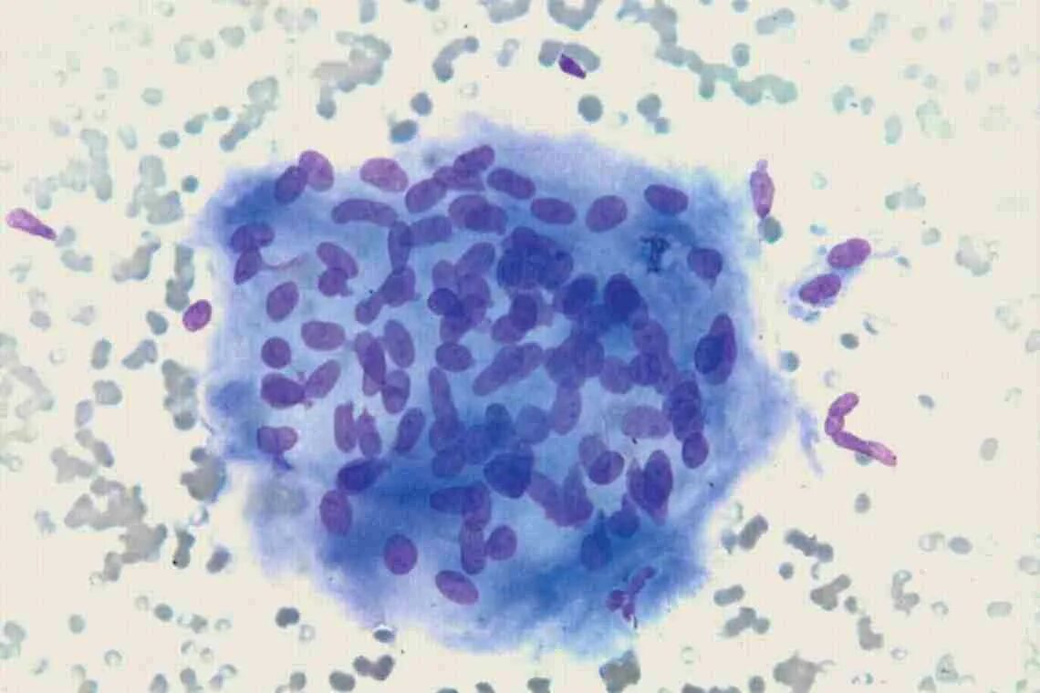 Бактериальный вагиноз микроскопия. Что такое ключевые клетки в мазке. Трихомонада под микроскопом. Микроскопия бактериального вагиноза. Бактериальный вагиноз микроскопия мазка.