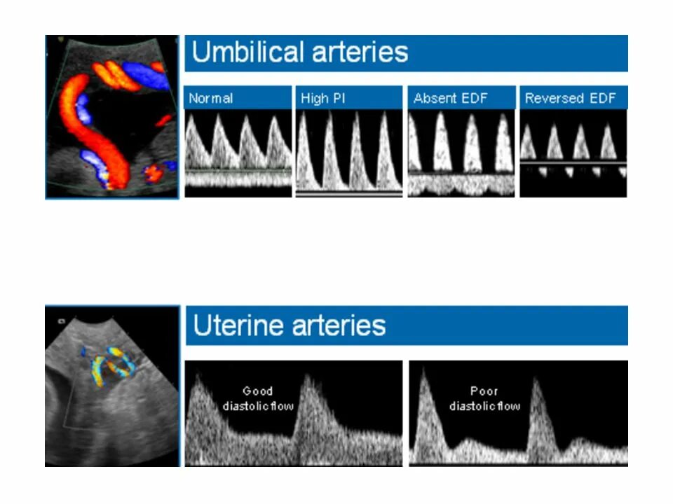 Доплер кровотоки. Допплерометрия маточных сосудов. Средняя мозговая артерия плода допплер. Допплерометрия средней мозговой артерии плода. Средняя мозговая артерия допплер норма.