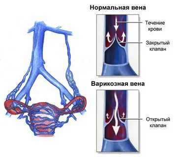 Венозное сплетение яичка