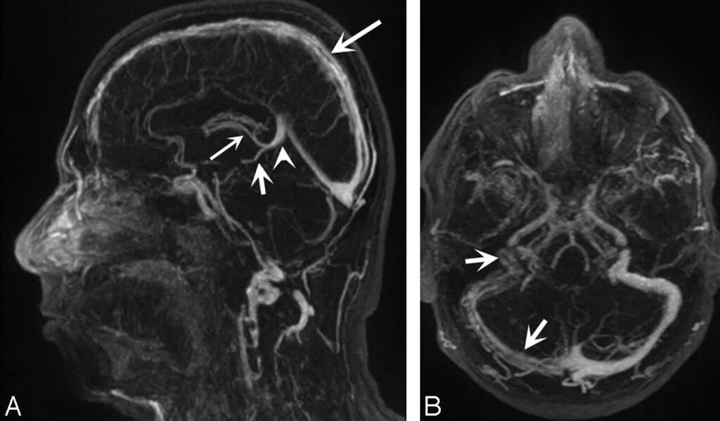 Сосуды головного мозга норма. Мрт сосудов головного мозга (мрт-ангиография). Мрт головного мозга с ангиографией. Магнитно-резонансная венография головного мозга. Мрт ангиография сосудов головного мозга с контрастом.
