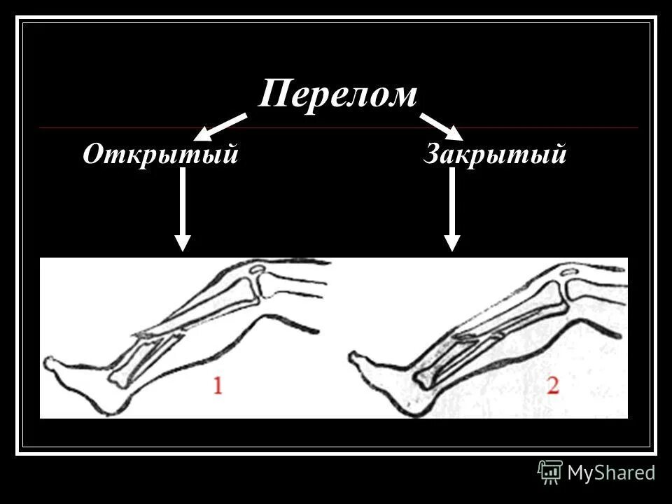 Открытый и закрытый перелом. Открытые и закрытые передома. Открытый перелом и закрытый перелом.