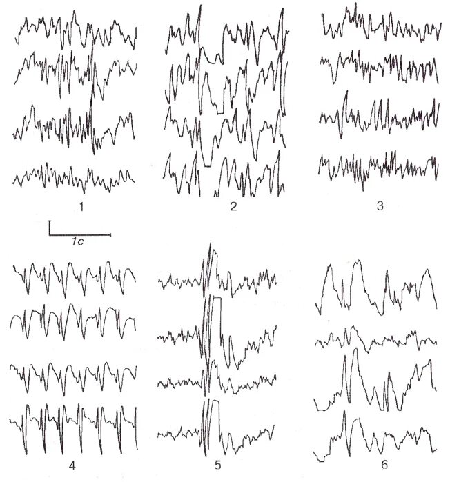 Спайки на ээг. ЭЭГ спайки и острые волны. Пик полипик волна на ЭЭГ. Спайк волна на ЭЭГ. Острая волна медленная волна на ЭЭГ.