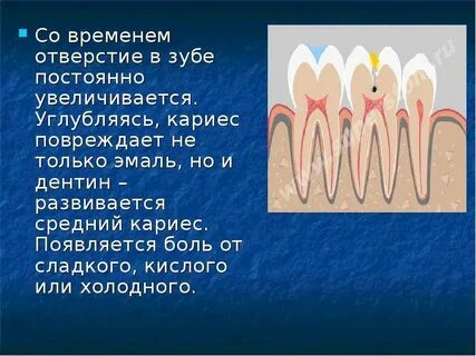 Возникновение кариеса