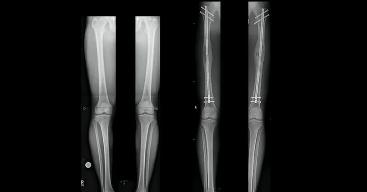 Аппарат Илизарова на бедре рентген. Аппарат Илизарова рентген до и после. Удлинение ног операция.